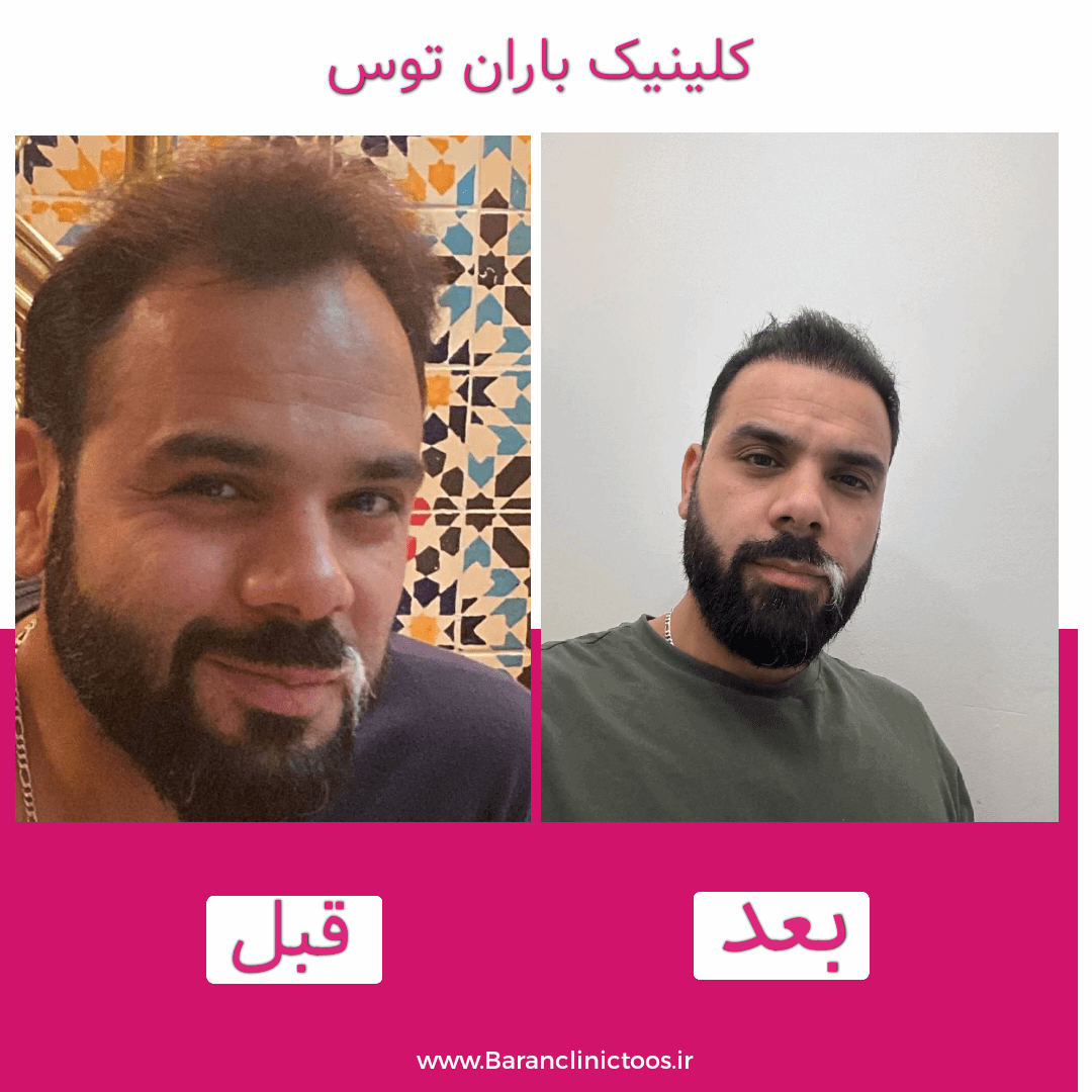 قبل و بعد کاشت مو